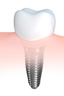 srvc-implants