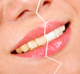 srvc-tooth-whitening